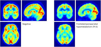 A Retrospective Case Series Analysis of the Relationship Between Phenylalanine: Tyrosine Ratio and Cerebral Glucose Metabolism in Classical Phenylketonuria and Hyperphenylalaninemia